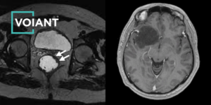 colorectal cancer CRC glioma GBM CNS tumor scan VOIANT MRI RECIST RANO